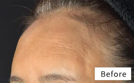 そんな方におすすめなのが前額リフト