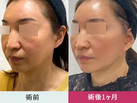 そんな方におすすめなのがフルフェイスリフト