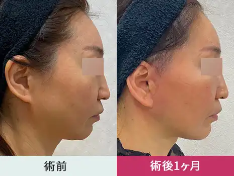 そんな方におすすめなのがフルフェイスリフト