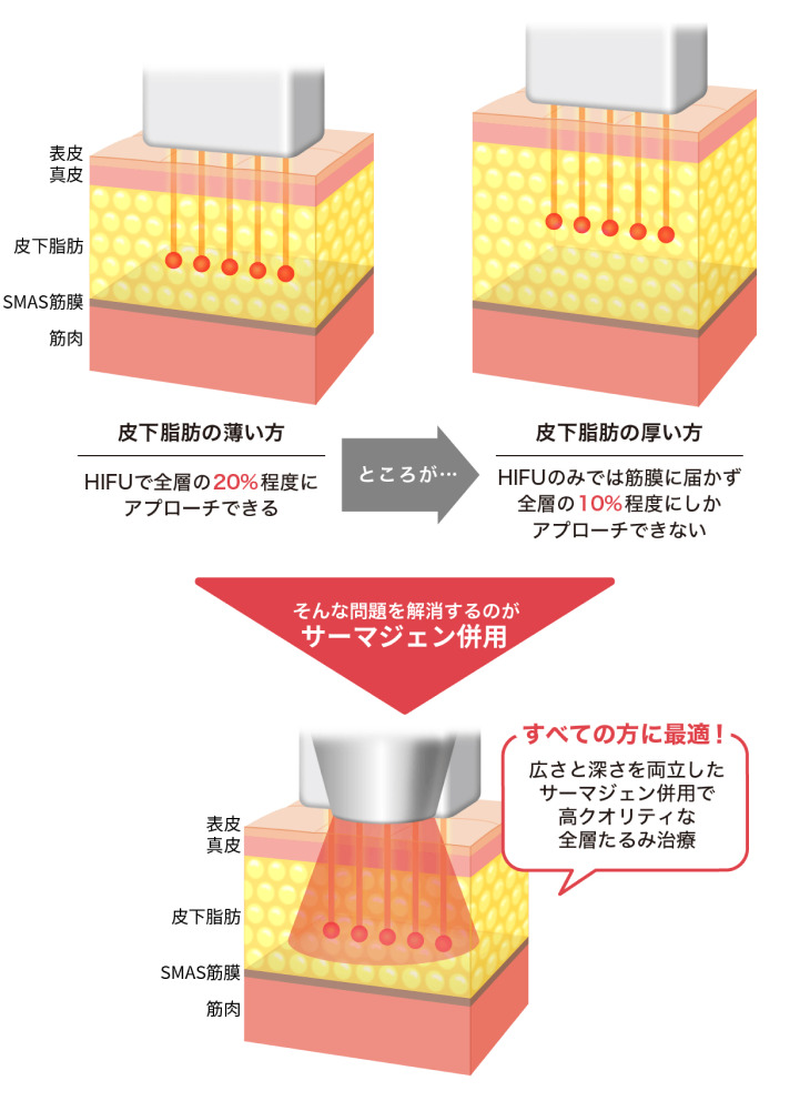 02 ハイフとのセットもおすすめ