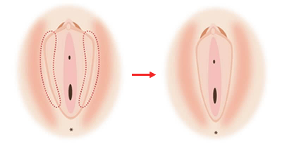 小陰唇縮小術｜Wi Clinic(ウィクリニック)【公式】