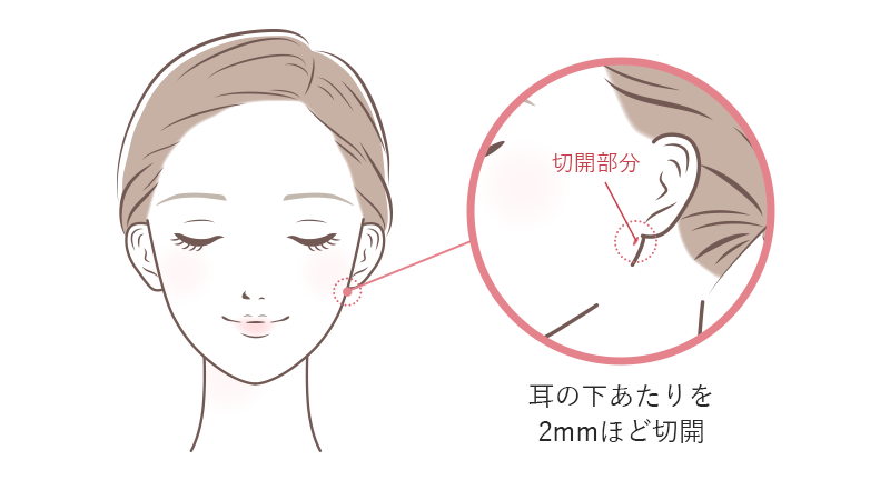 01 傷跡がほとんど残らないため、仕上がりはとても自然